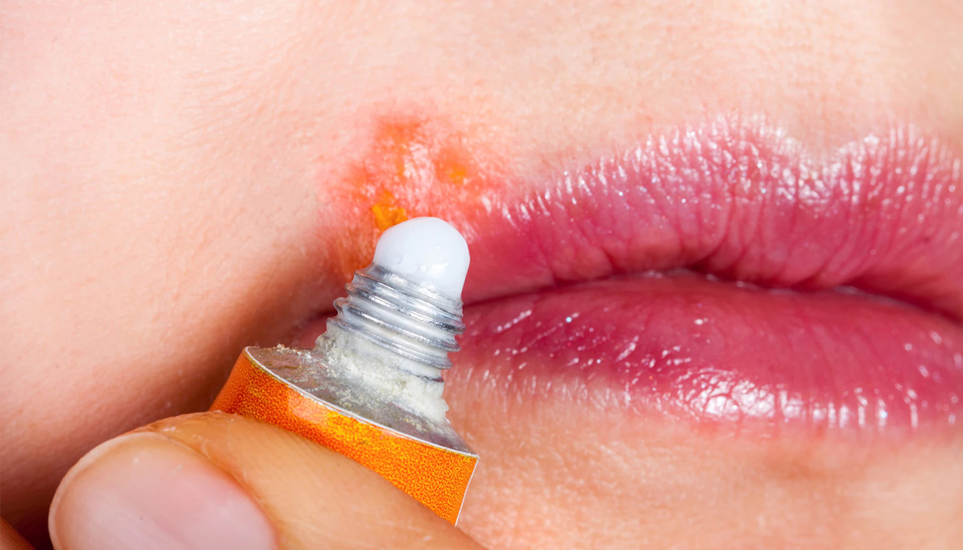 Cold Sore Treatment