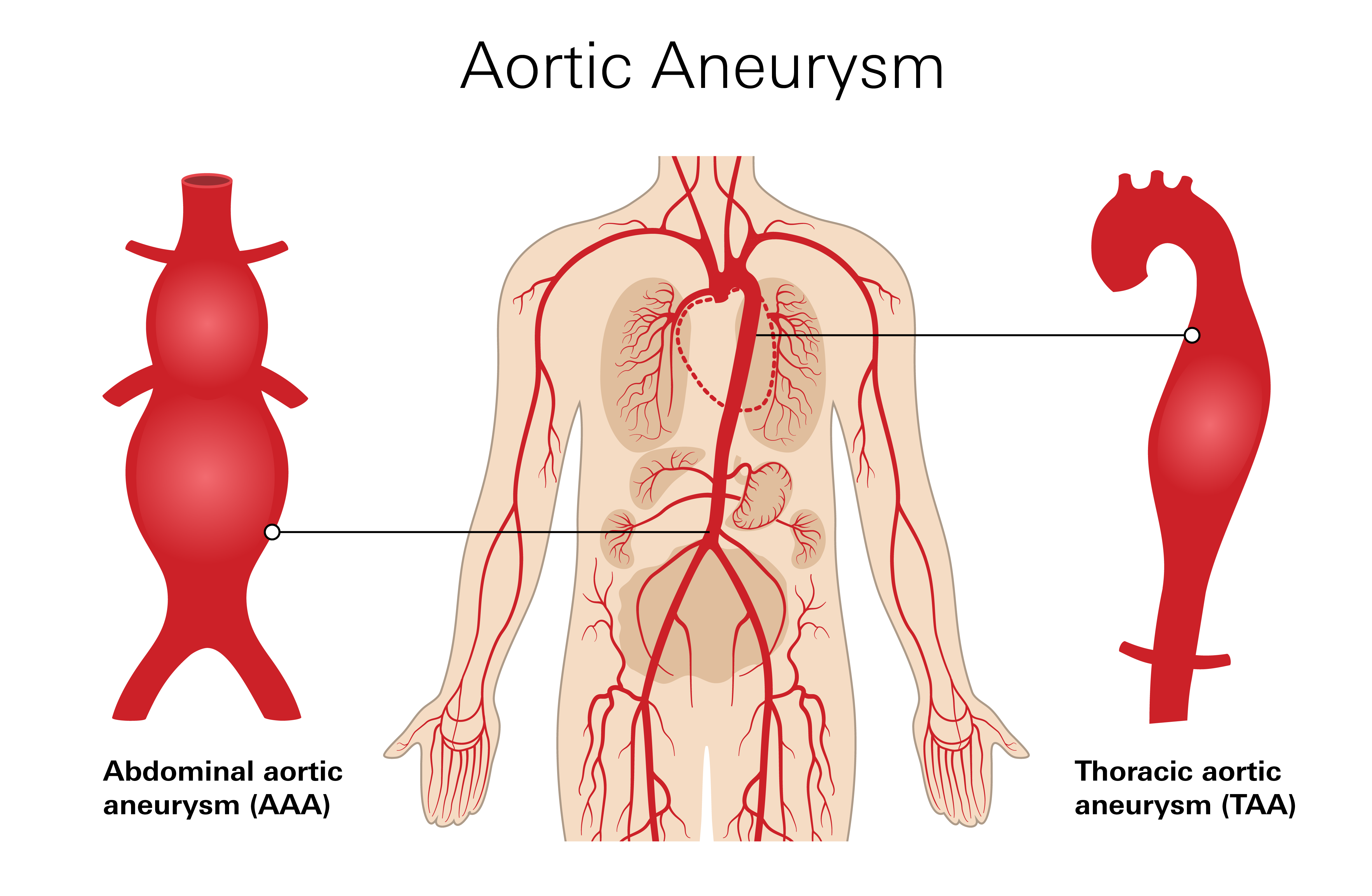 Aortic Aneurysm