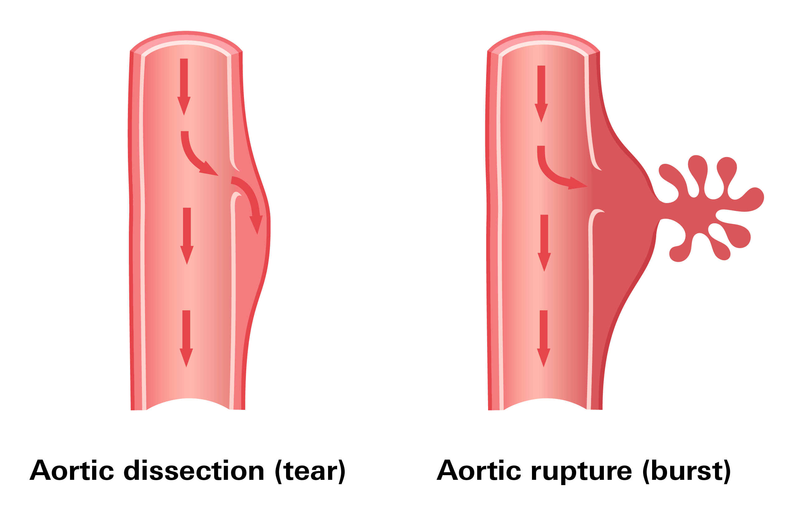 Aortic dissection and rupture