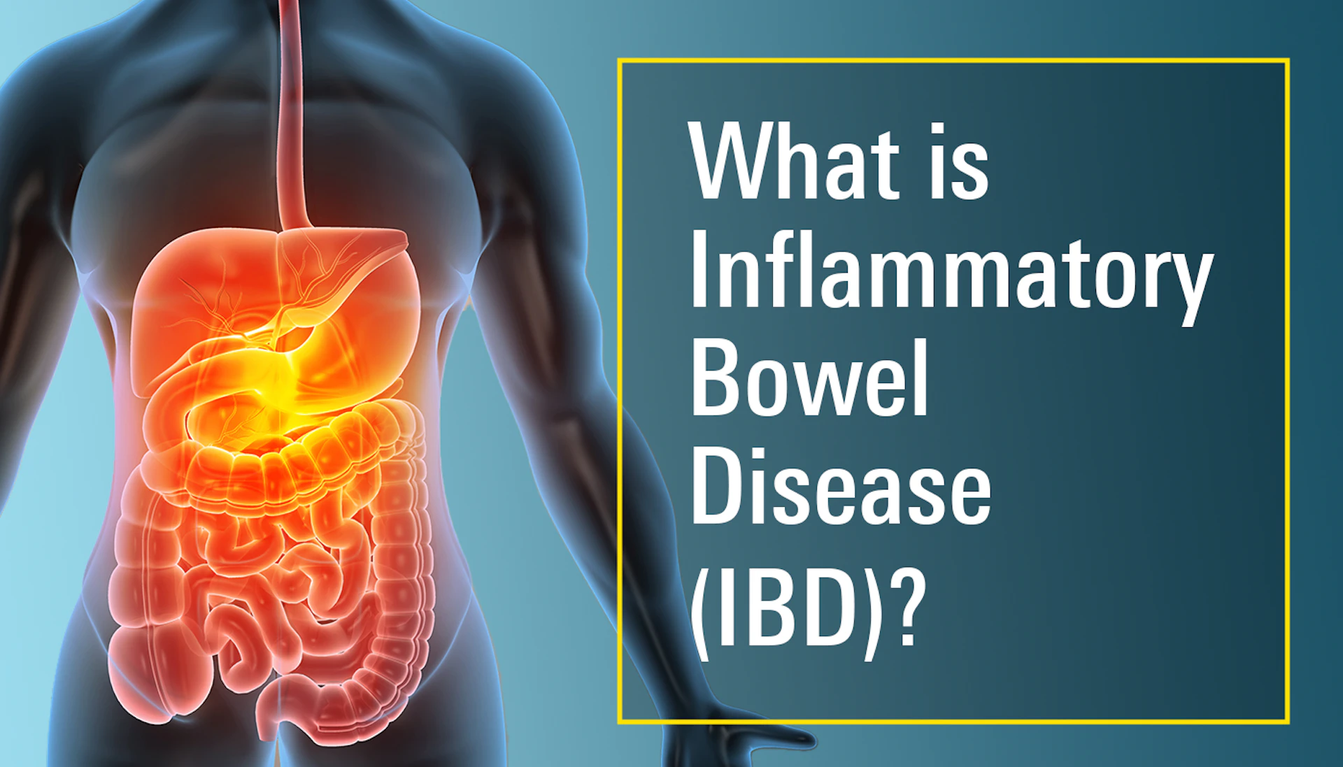 What Is Inflammatory Bowel Disease (IBD)? Key Facts