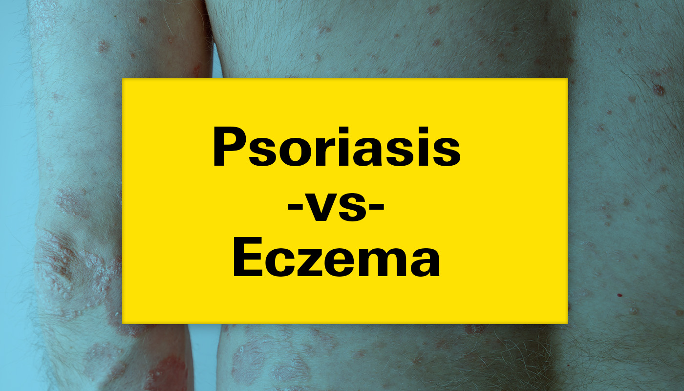 Psoriasis Vs. Eczema: Understanding The Differences And Effective ...