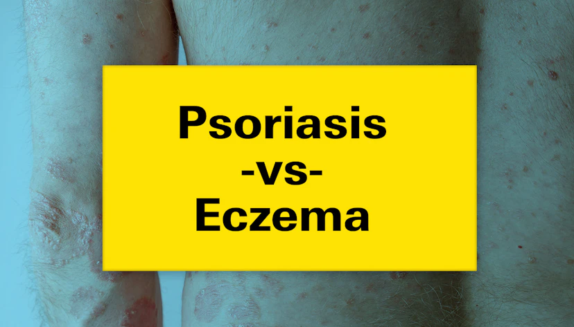 Psoriasis Vs Eczema