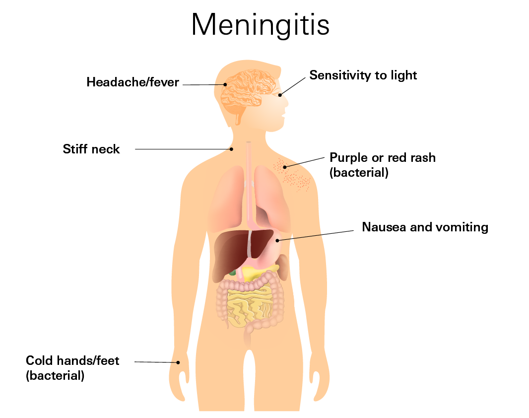 Meningitis Symptoms