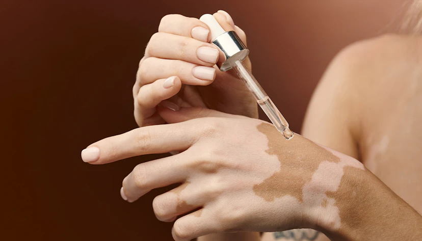 Vitiligo