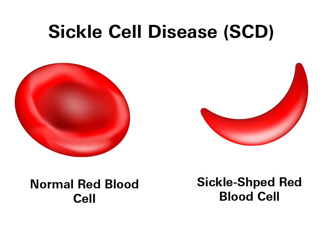 Sickle Shaped Red Blood Cell