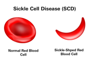 Sickle Cell Disease