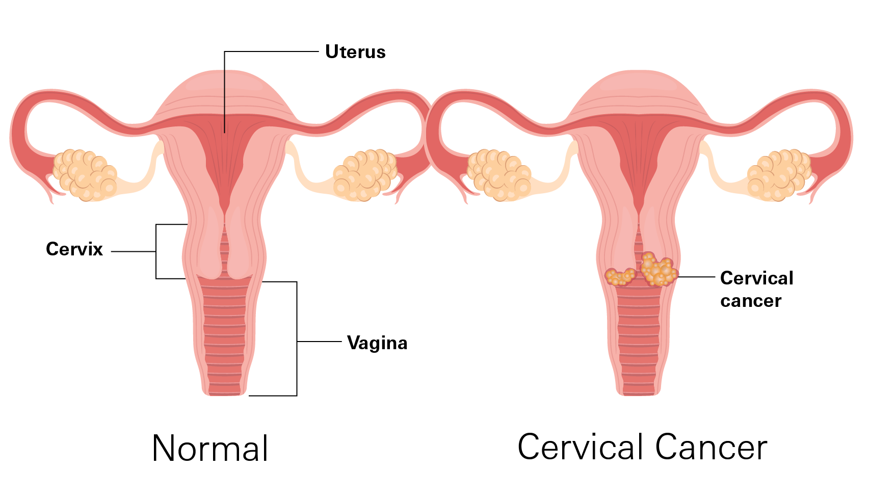 Cervical Cancer