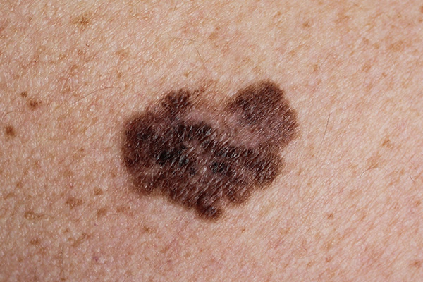 Melanoma