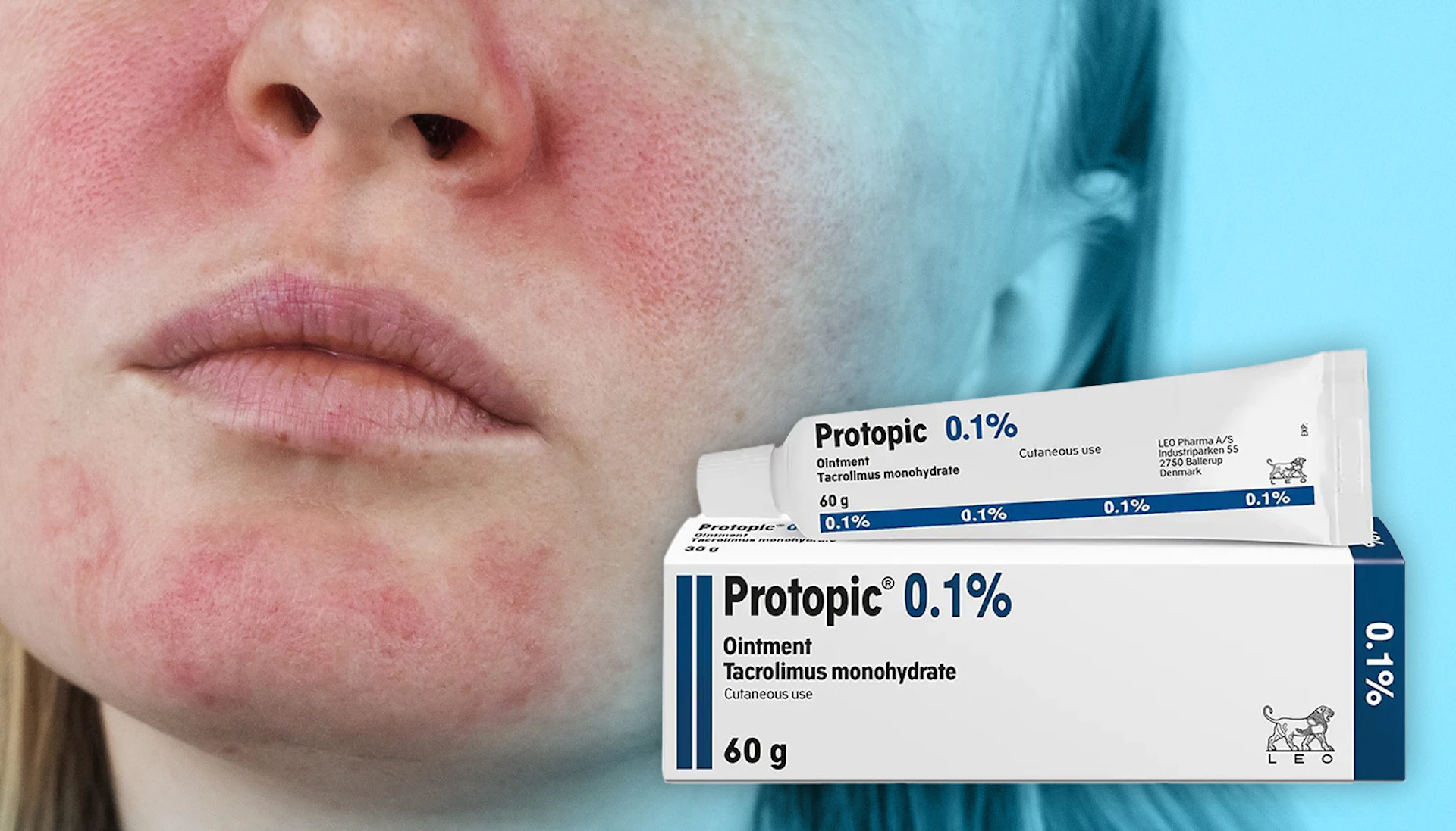 Protopic Ointment