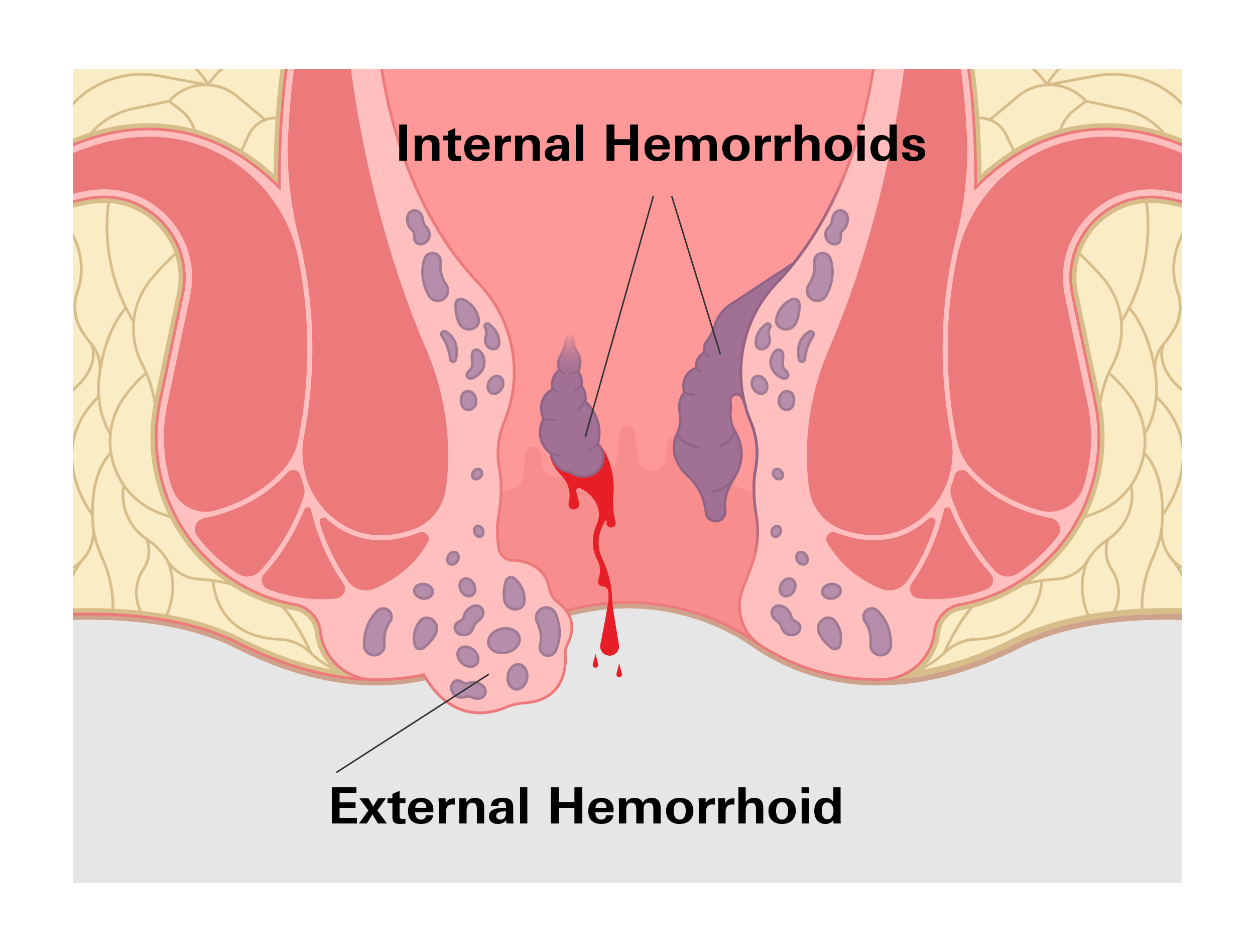 Hemorrhoids