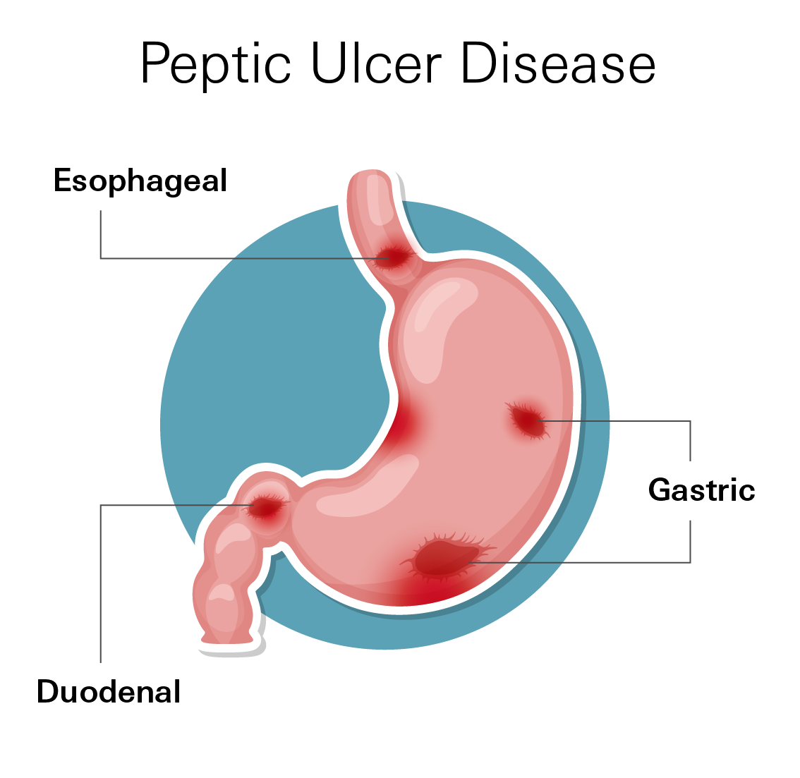 Peptic Ulcer Disease
