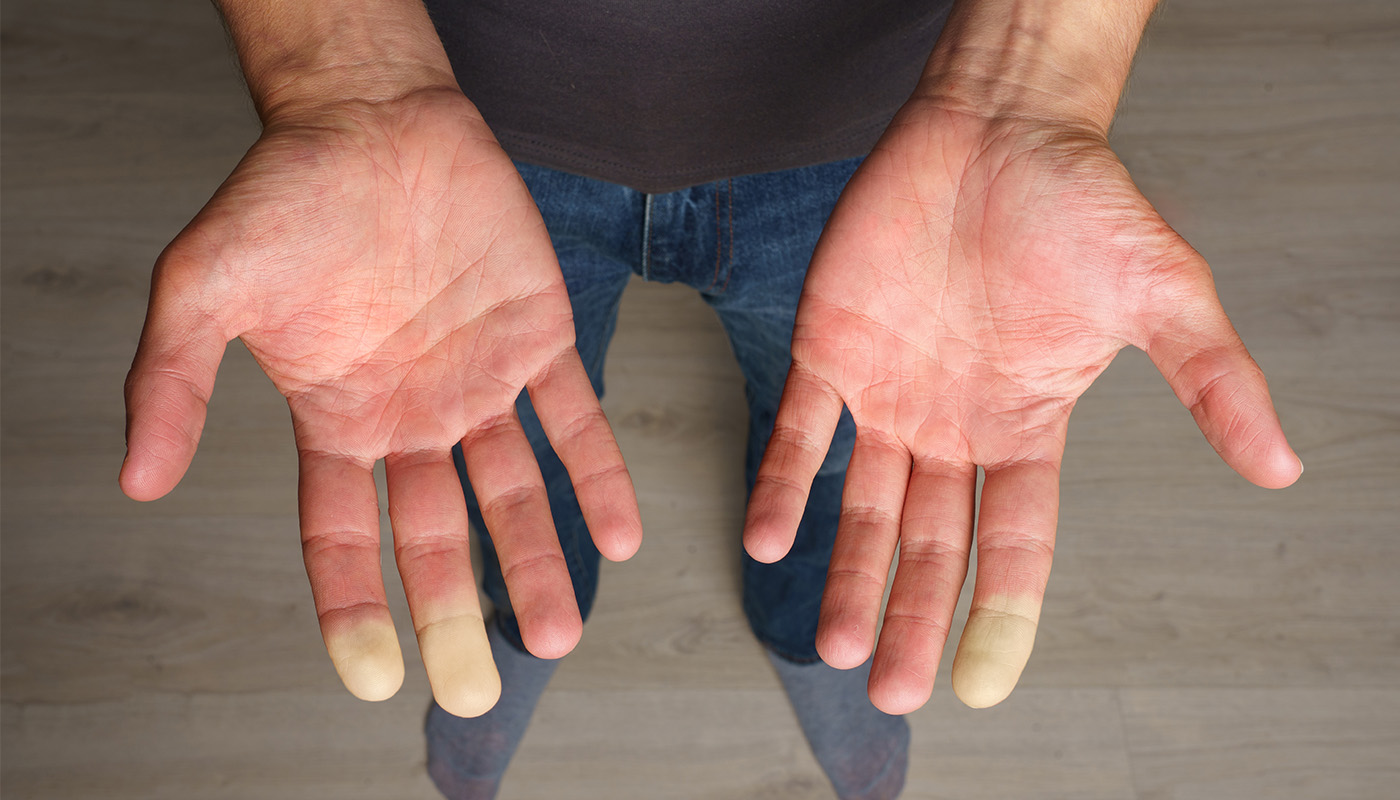 Raynaud's Syndrome
