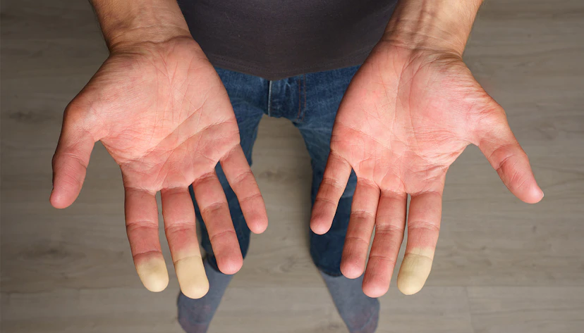 Raynauds
