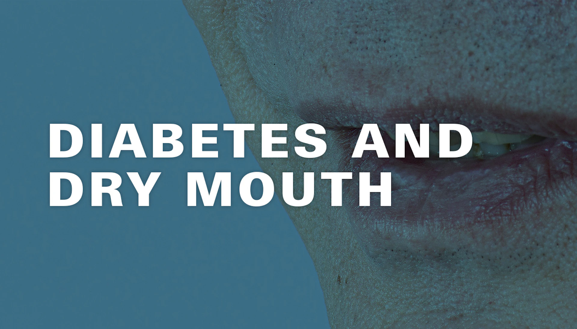 Diabetes And Dry Mouth