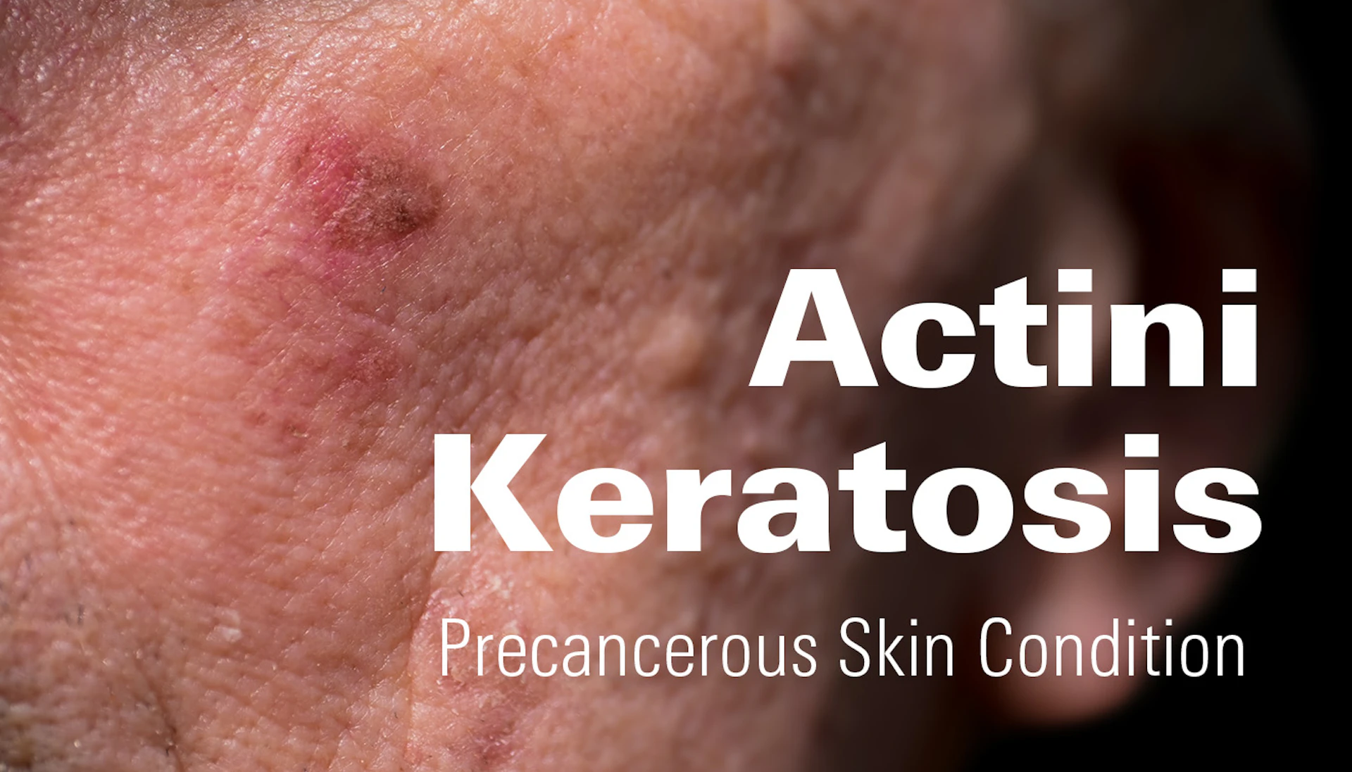 Actini Keratosis