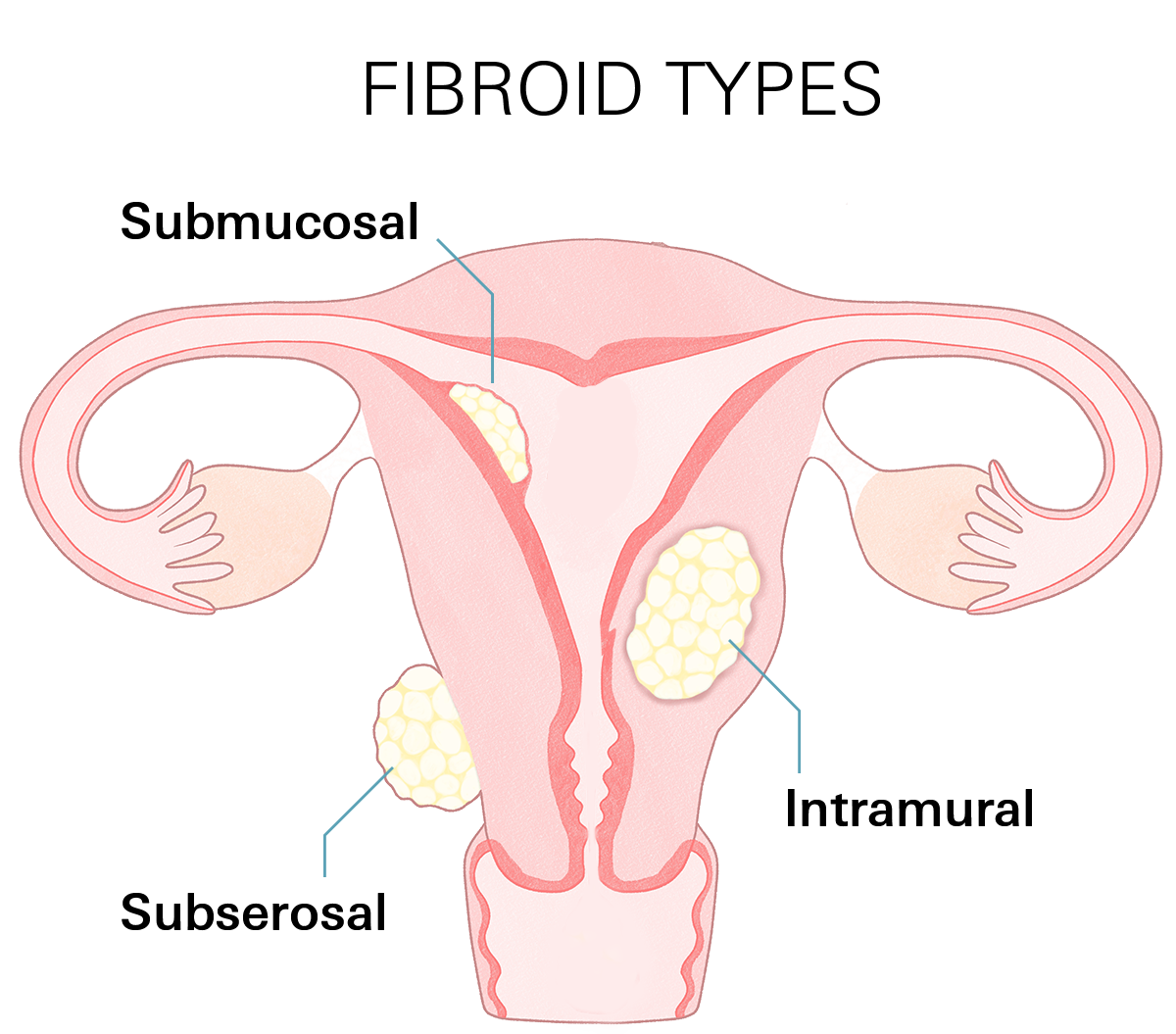 Types of Fibroids