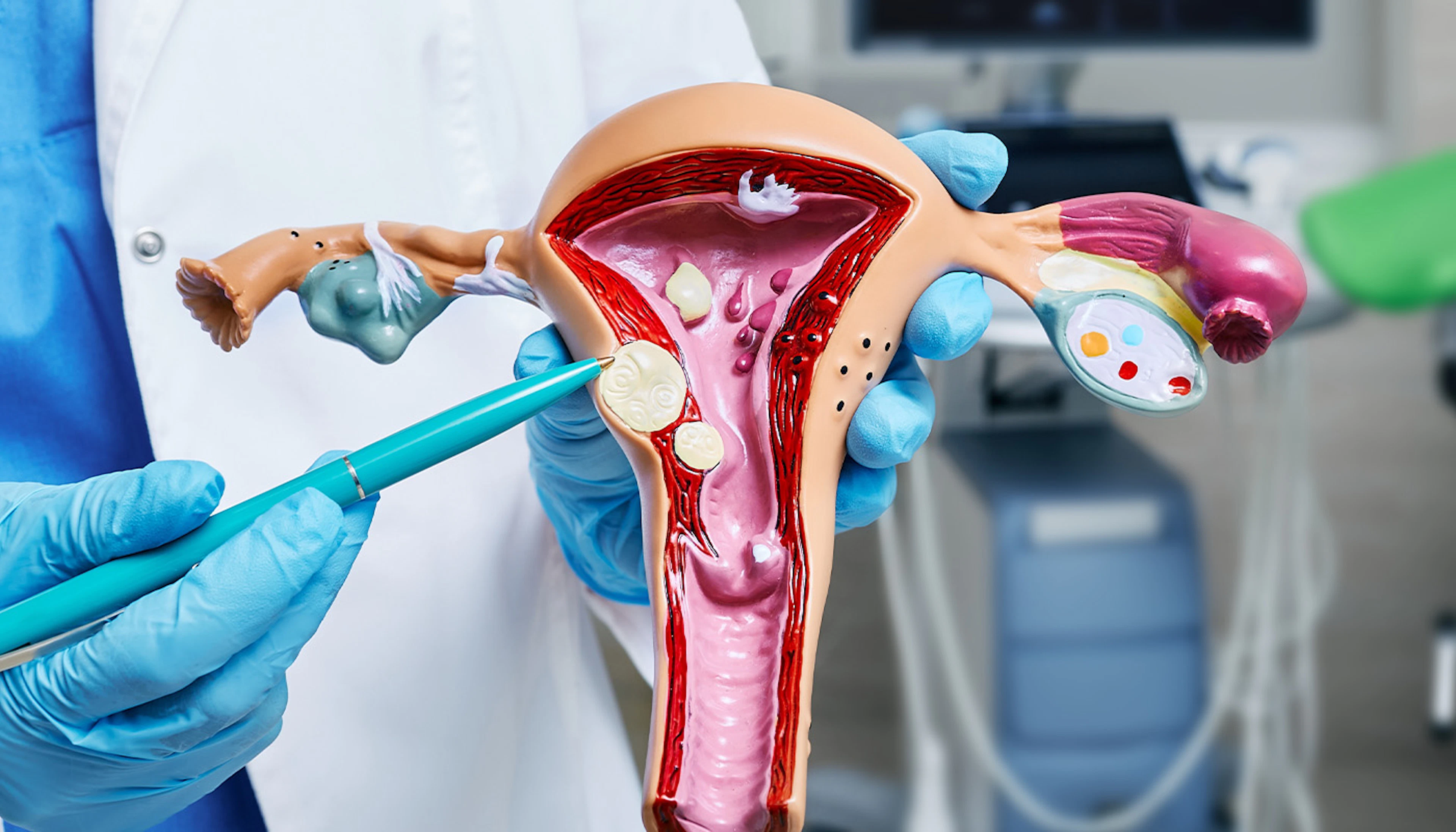 Uterine Fibroids