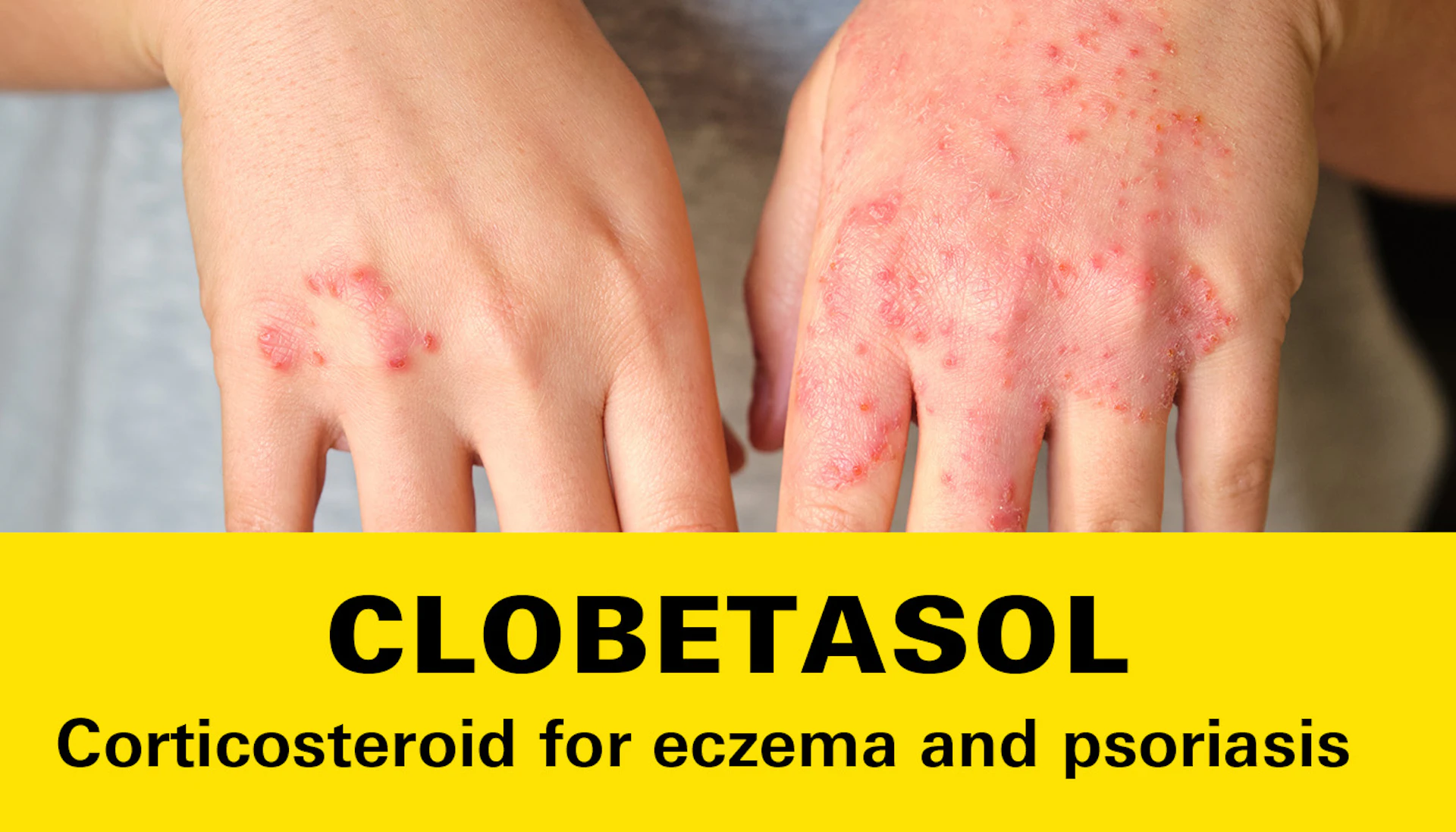 Clobetasol
