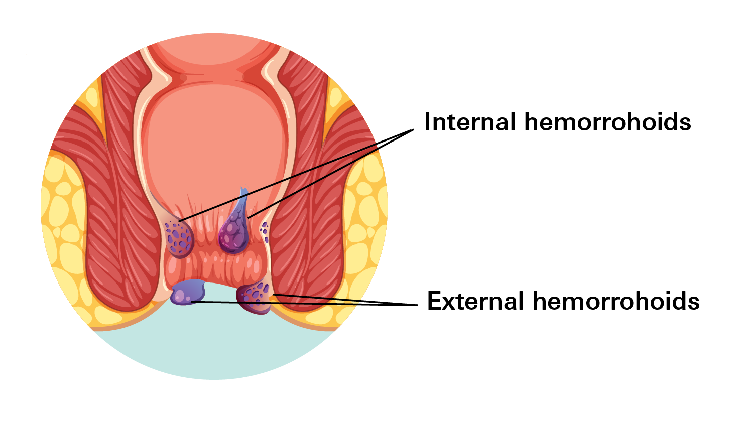 Hemorrhoids