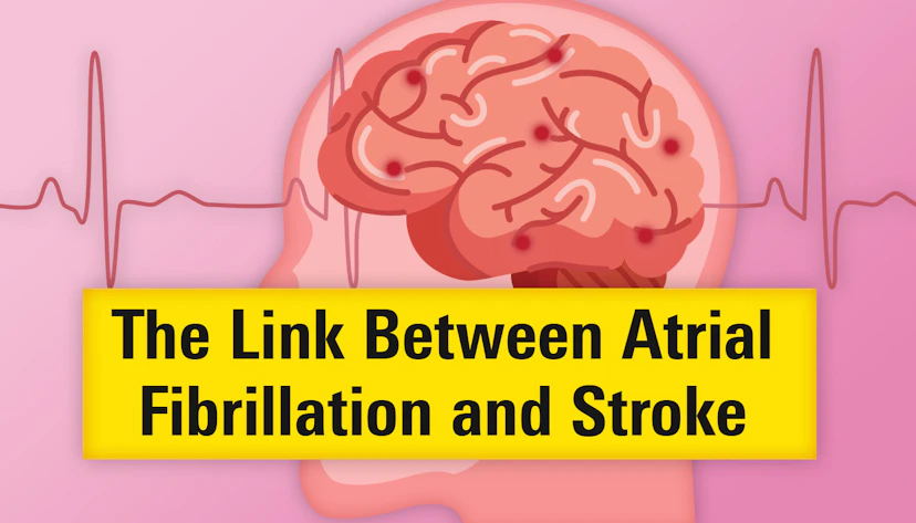Atrial Fibrillation And Stroke