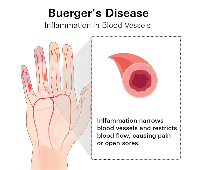 Buergers Disease