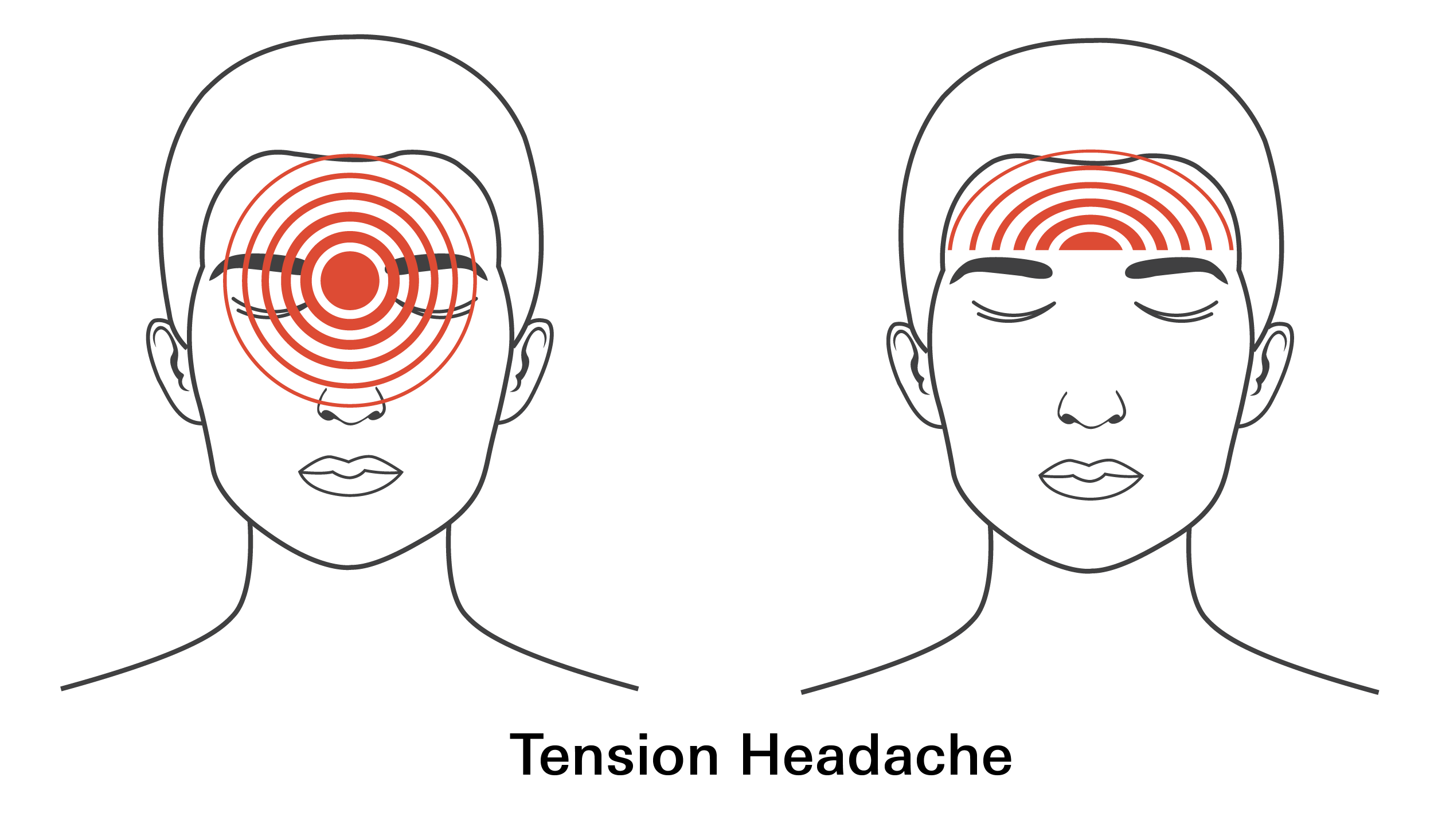 Tension Headache
