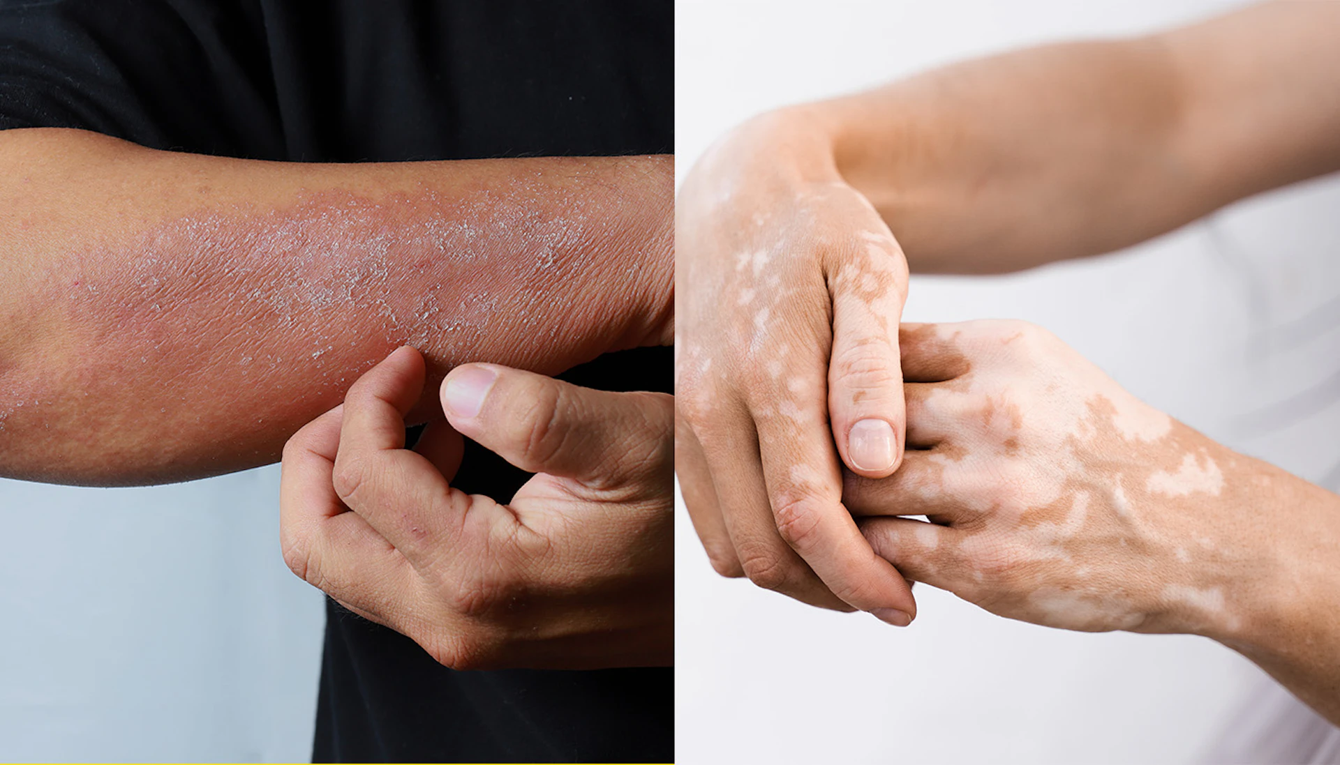 Vililogo And Eczema
