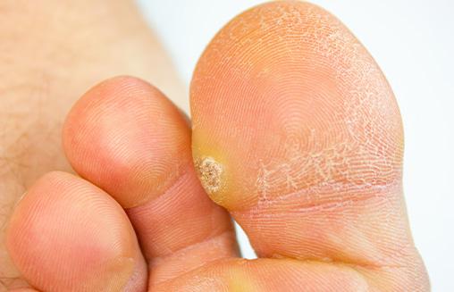wart on foot