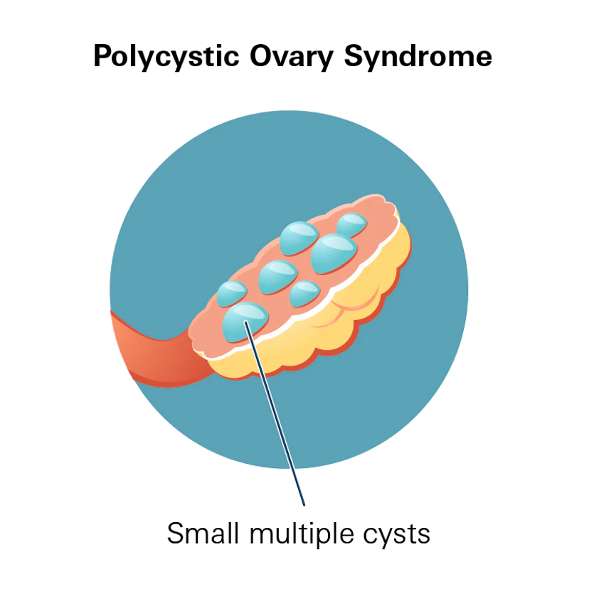 Polycystic Ovary Syndrome