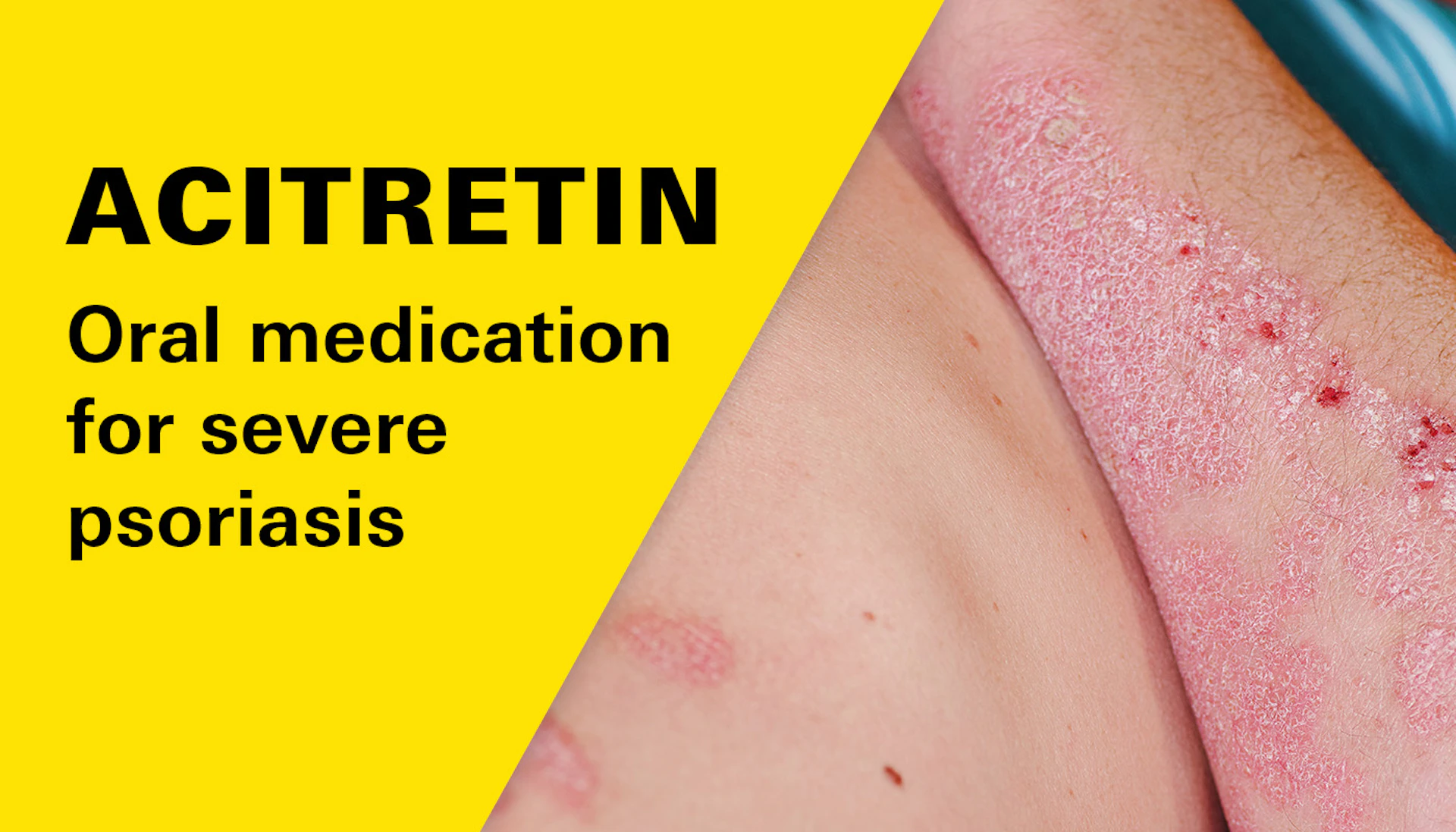 Acitretin