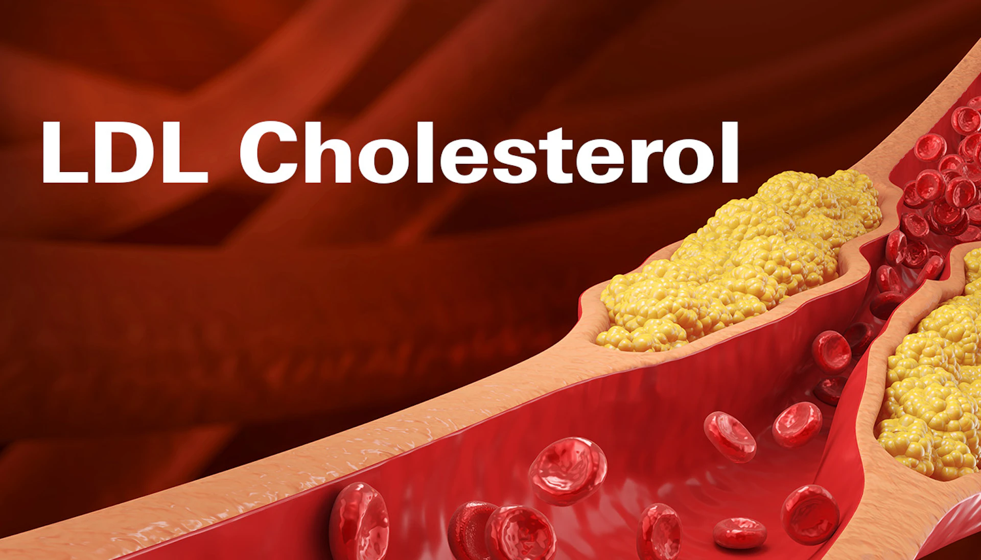 Ldl Cholesterol