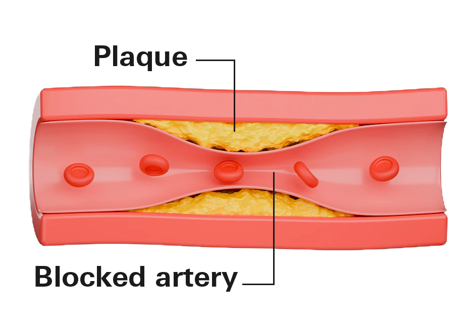 Plaque buildup