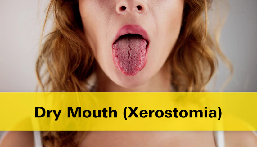 Dry Mouth