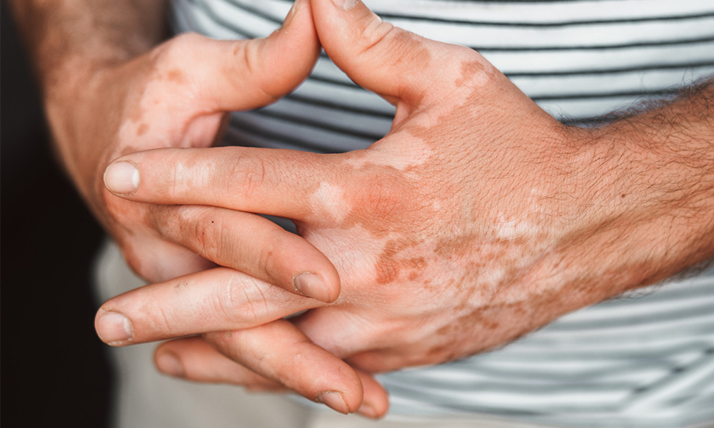 Vitiligo