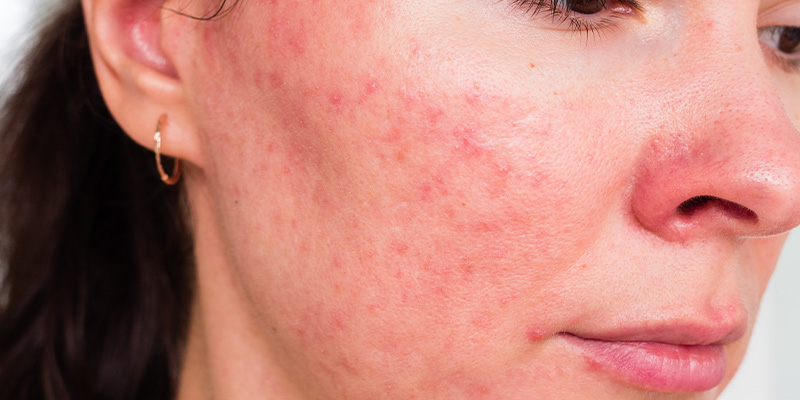 Rosacea