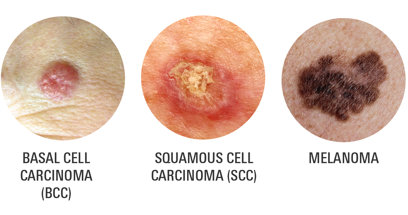 Skin Cancer Types