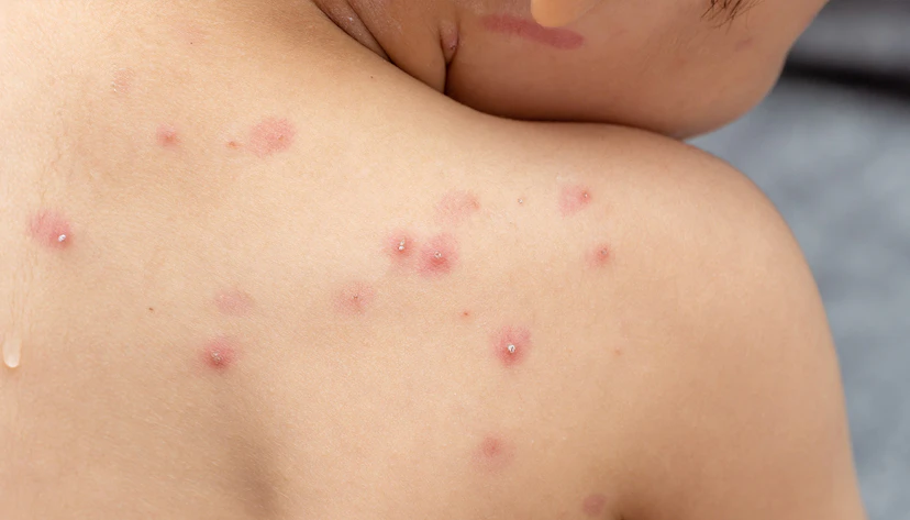 Chickenpox
