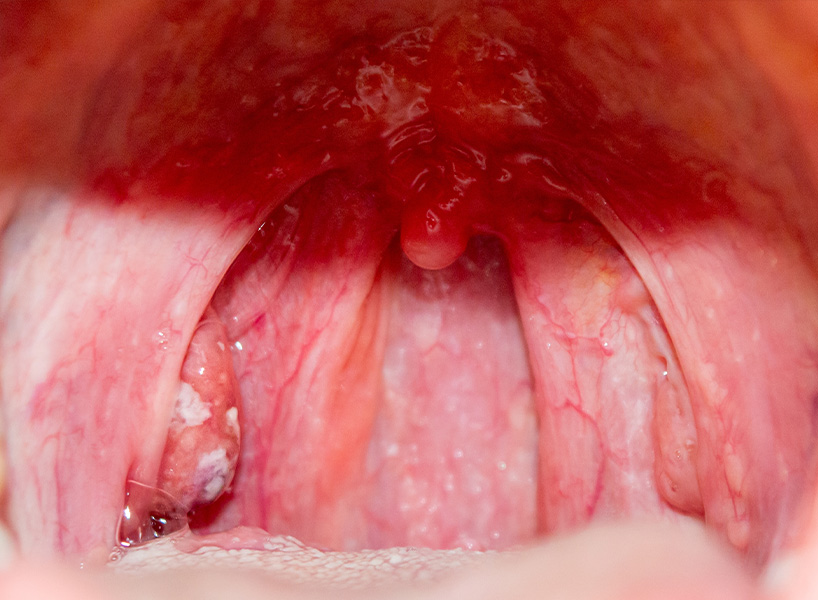Tonsillitis