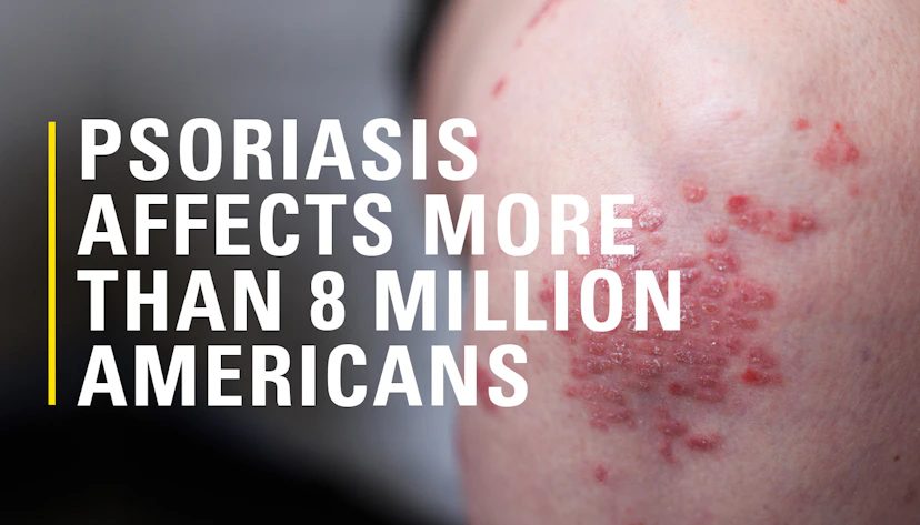 Psoriasis