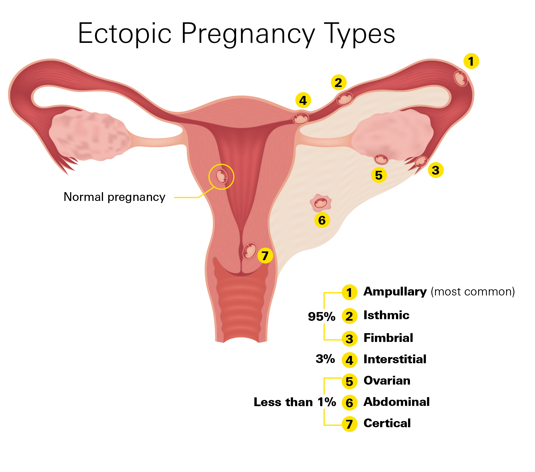Ectopic Pregnancy Types