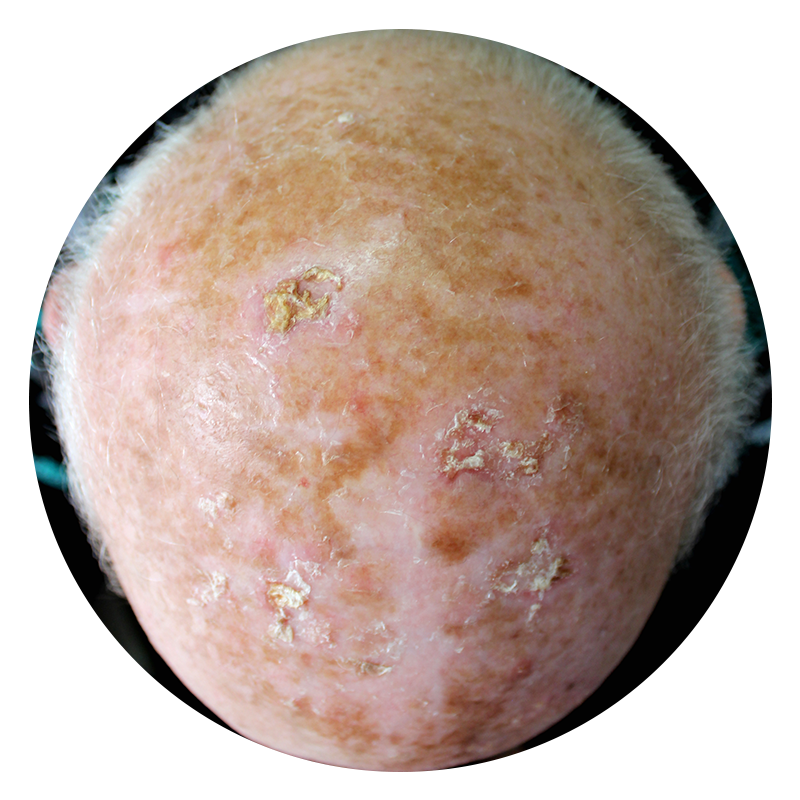 actinic keratosis