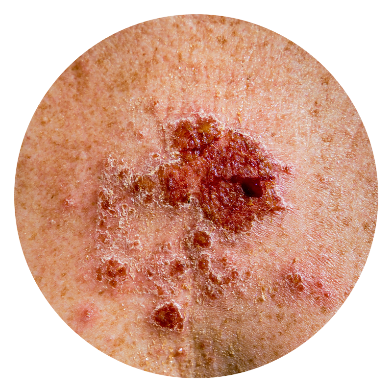 superficial basal cell carcinoma