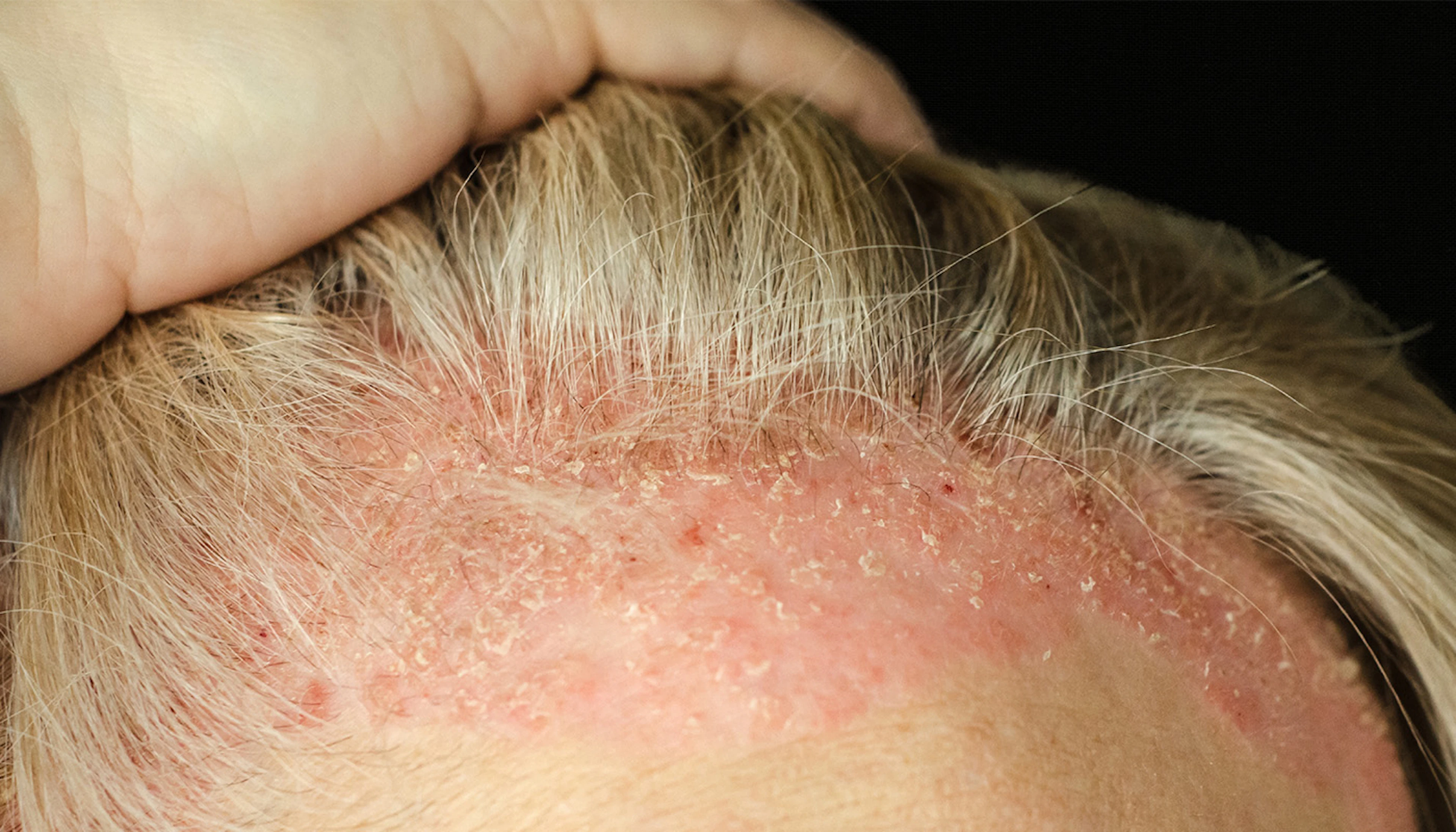 Products For Psoriasis