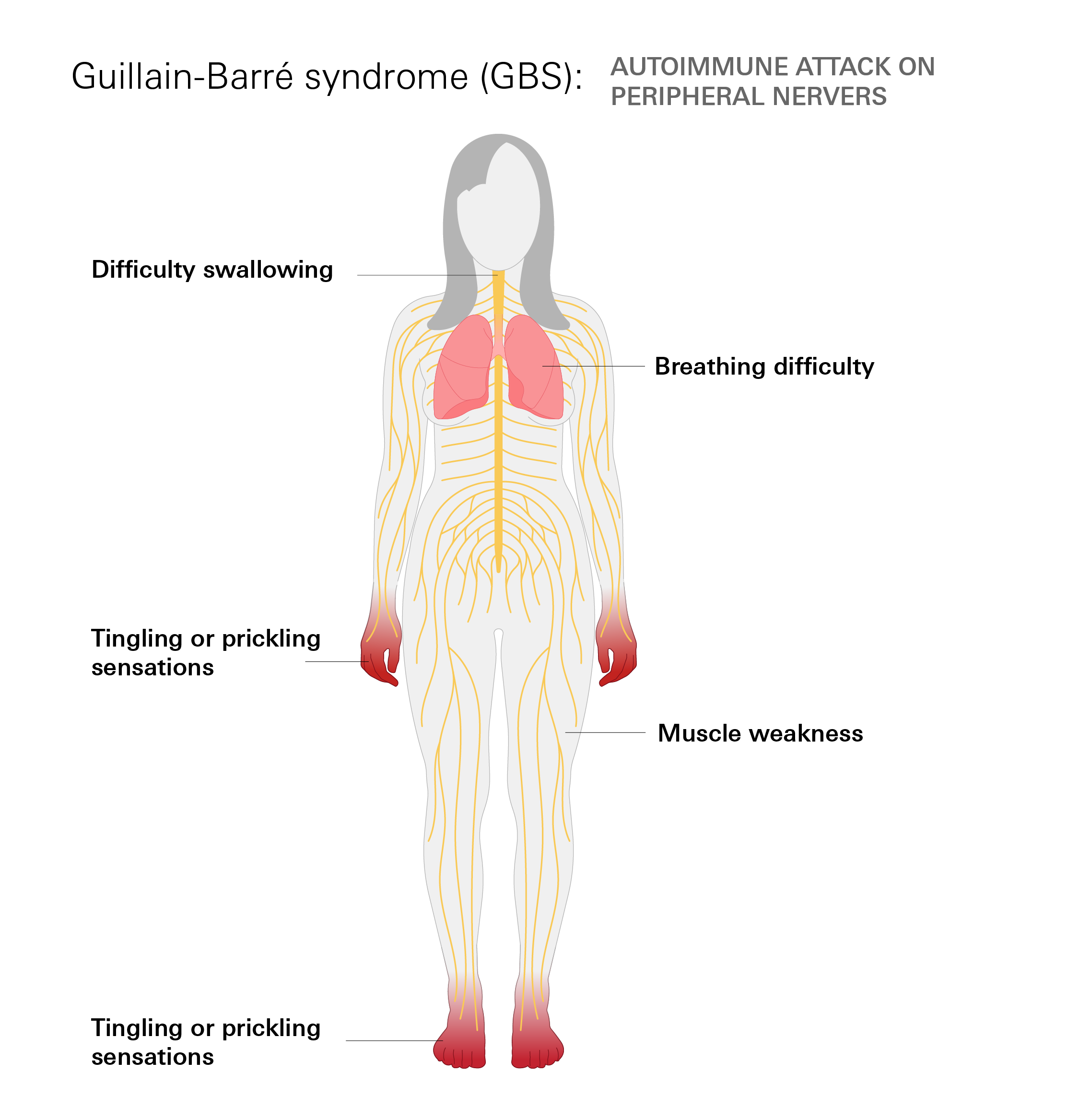 Guillain-Barré syndrome (GBS)
