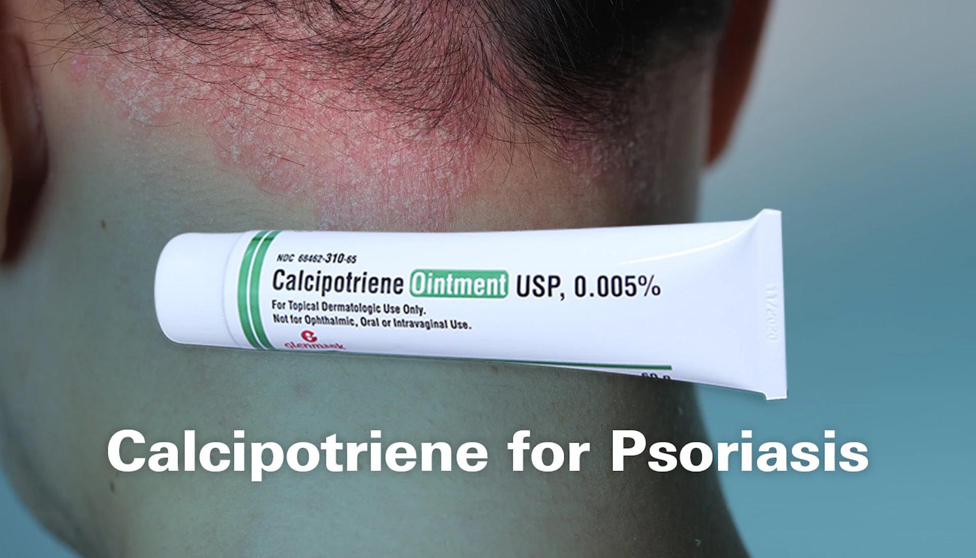 Calcipotriene