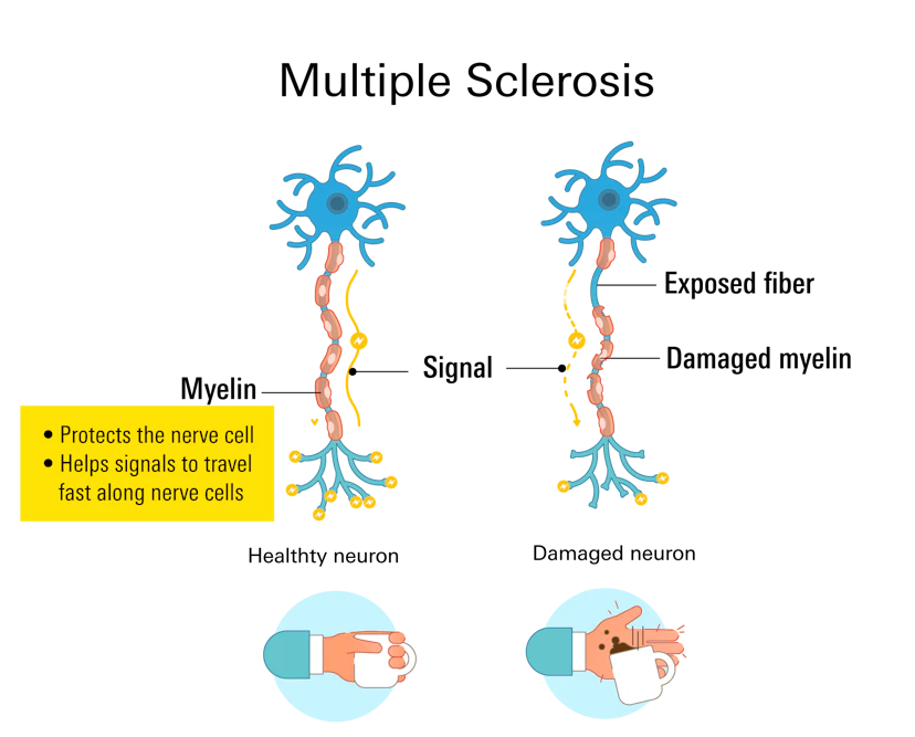 Multiple Sclerosis
