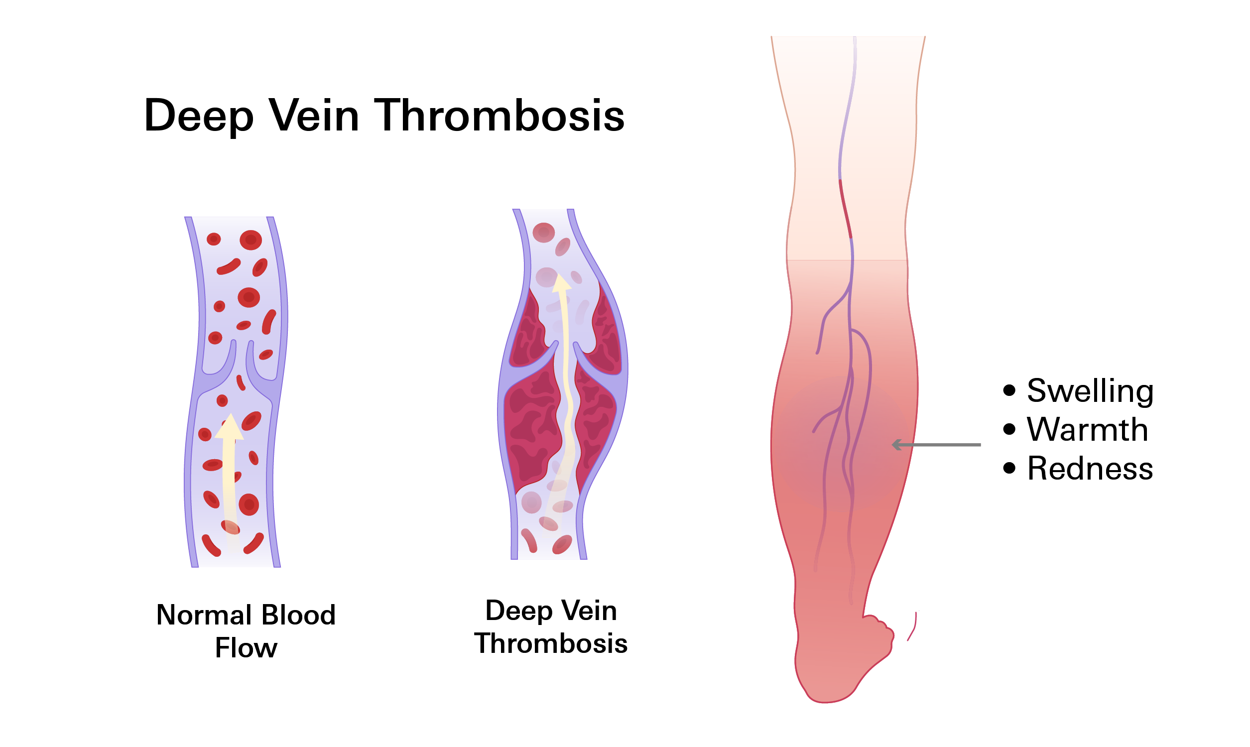 Deep Vein Thrombosis