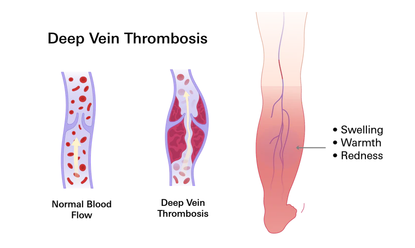 Deep Vein Thrombosis