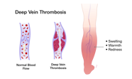 Deep Vein Thrombosis DVT 