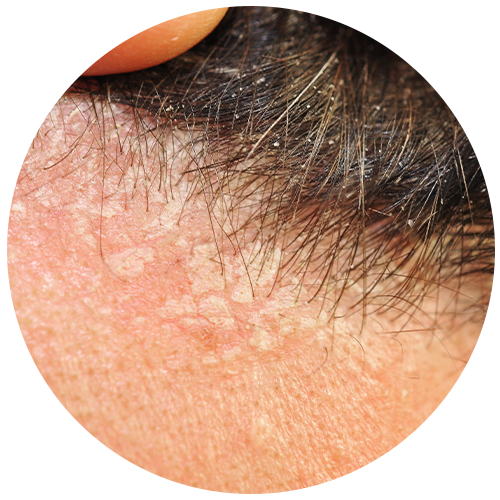 Seborrheic Dermatitis